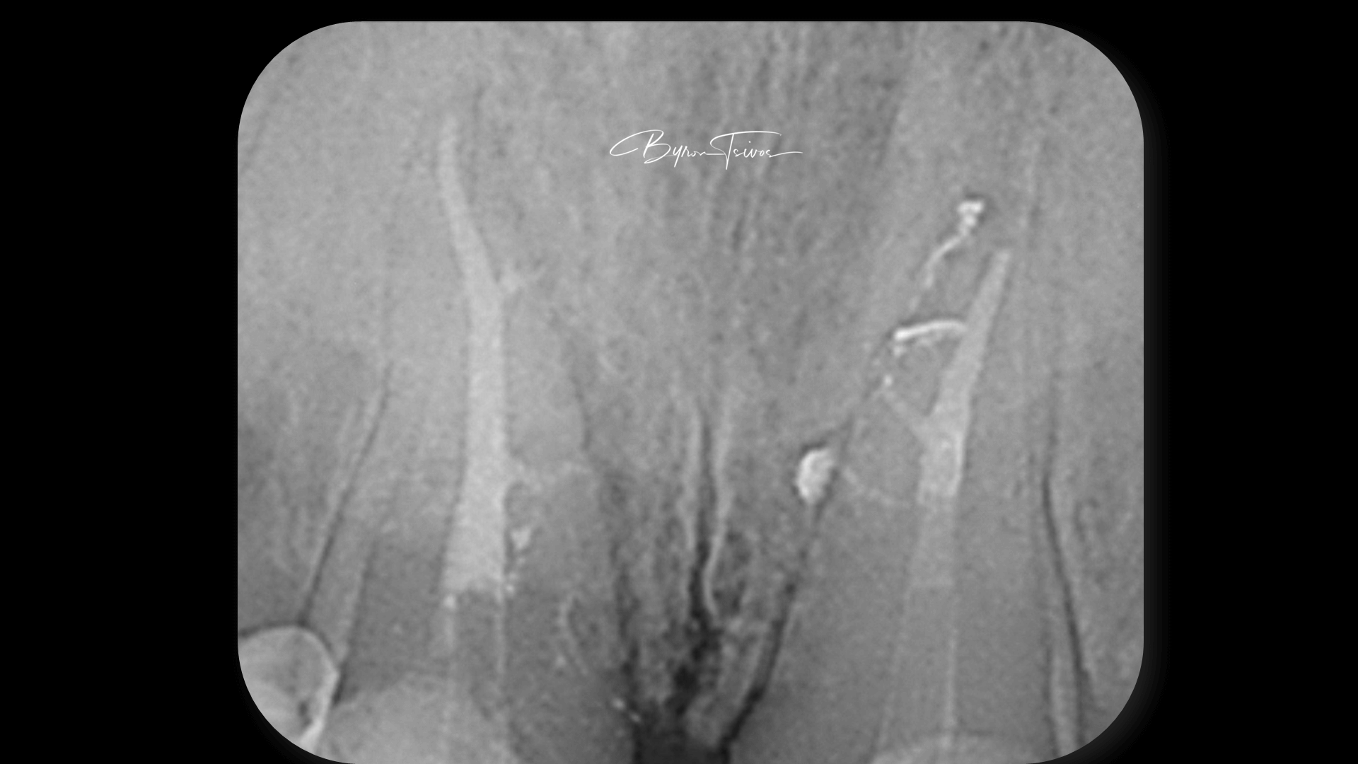 Broken Instrument Removal - Case 6